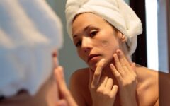 5-principais-tipos-de-acne-e-como-trata-las